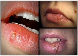 fast treatment for cold sores